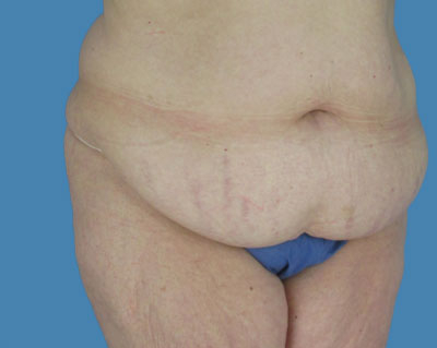 1740677426 body lipotuck p107 row 1 column 1