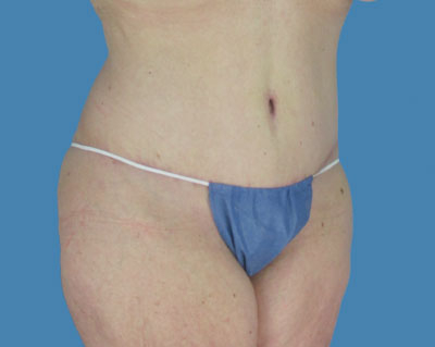 1740677433 body lipotuck p107 row 1 column 2