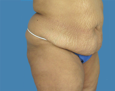 1740677439 body lipotuck p61 row 1 column 1