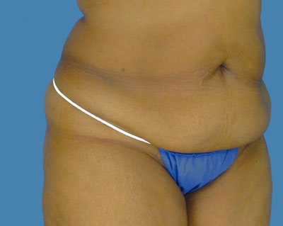 1740677453 body lipotuck p103 row 1 column 1