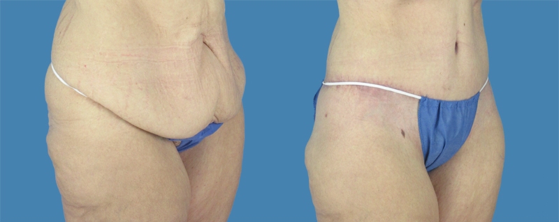 1740677774 body lipotuck p35