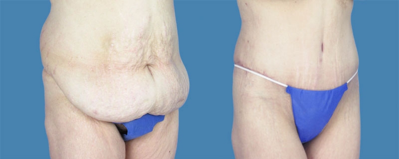 1740677778 body lipotuck p26