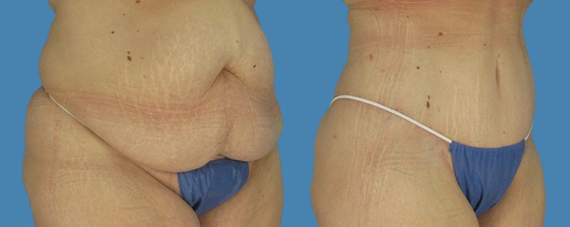 1740677781 body lipotuck p10