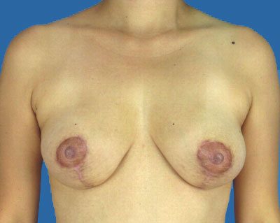 1740678311 breast breast lift p15 2 row 1 column 2