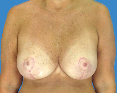 1740678318 breast breast lift p13 2 row 1 column 2