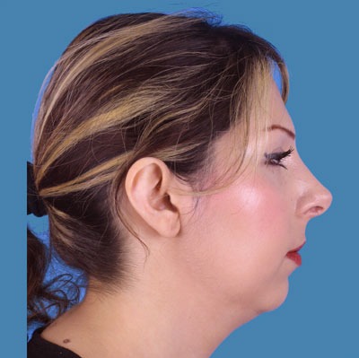 1740678396 face rhinoplasty p6 4 row 1 column 2