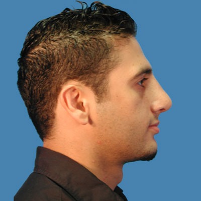 1740678399 face rhinoplasty p8 4 row 1 column 2