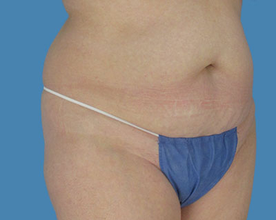 1740678452 body lipotuck p18 row 1 column 1