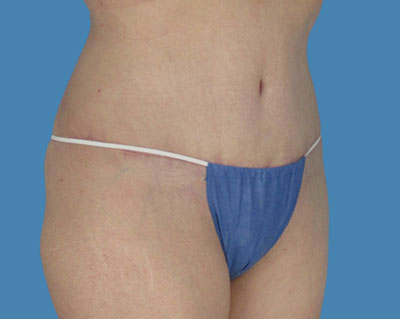 1740678455 body lipotuck p18 row 1 column 2