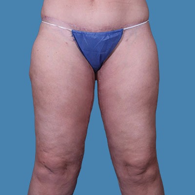 After Thigh Lift Sugar land TX