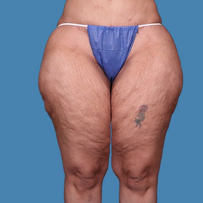 Before Thigh Lift Treatment Houston
