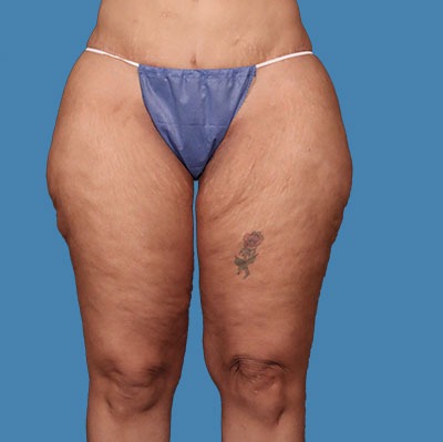 After Thigh Lift Treatment Houston