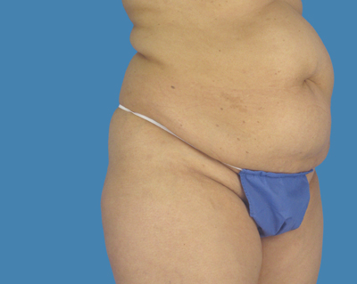 1740678470 body lipotuck p39 row 1 column 1