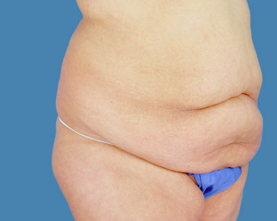 1740678476 body lipotuck p38 row 1 column 1