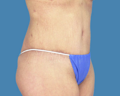 1740678479 body lipotuck p38 row 1 column 2
