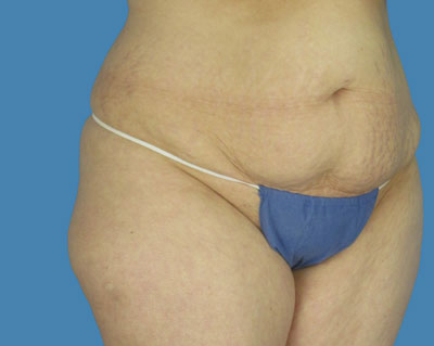 1740678483 body lipotuck p33 row 1 column 1