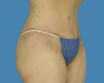 1740678486 body lipotuck p33 row 1 column 2