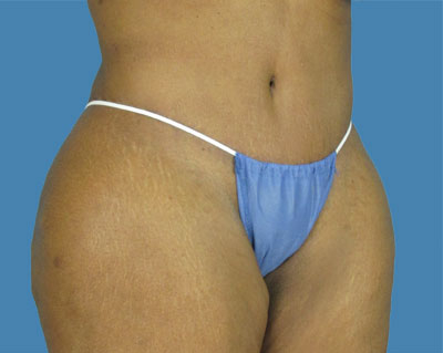 1740678498 body lipotuck p32 row 1 column 2