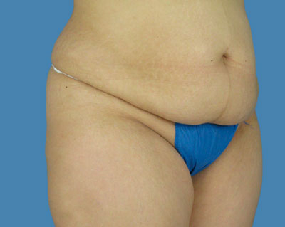 1740678501 body lipotuck p31 row 1 column 1