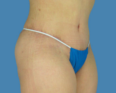 1740678504 body lipotuck p31 row 1 column 2