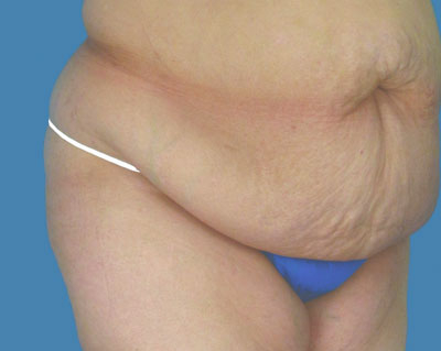 1740678507 body lipotuck p30 row 1 column 1