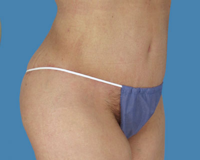 1740678510 body lipotuck p30 row 1 column 2