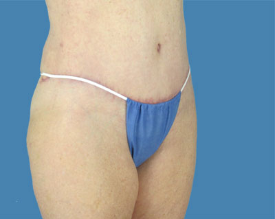 1740678522 body lipotuck p27 row 1 column 2