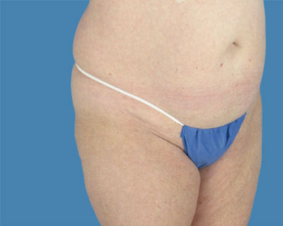 1740678530 body lipotuck p25 row 1 column 1