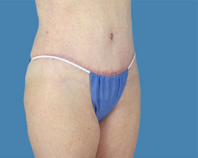 1740678532 body lipotuck p25 row 1 column 2