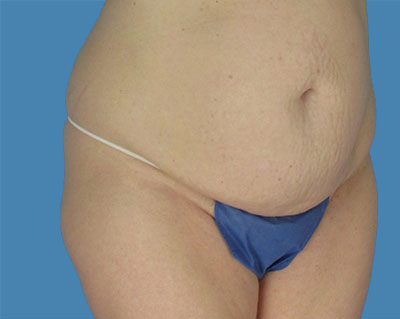 1740678541 body lipotuck p22 row 1 column 1