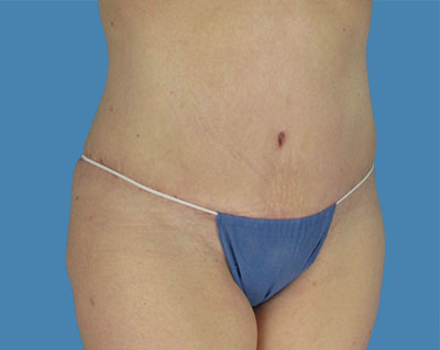 1740678544 body lipotuck p22 row 1 column 2