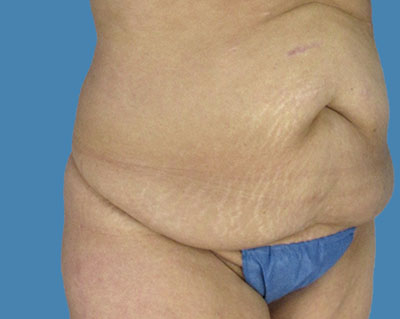 1740678553 body lipotuck p19 row 1 column 1
