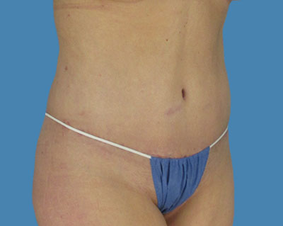 1740678557 body lipotuck p19 row 1 column 2