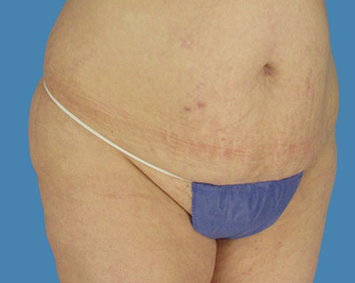 1740678560 body lipotuck p17 row 1 column 1