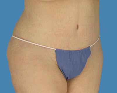 1740678563 body lipotuck p17 row 1 column 2