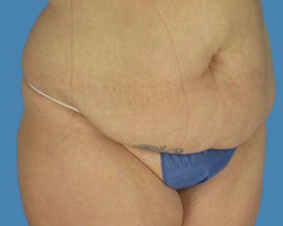 1740678566 body lipotuck p16 row 1 column 1