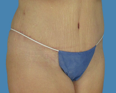 1740678569 body lipotuck p16 row 1 column 2