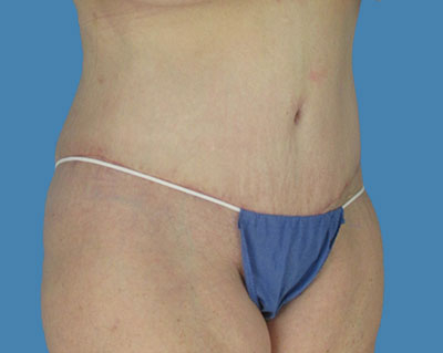 1740678575 body lipotuck p15 row 1 column 2