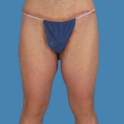 After Thigh Lift Houston TX