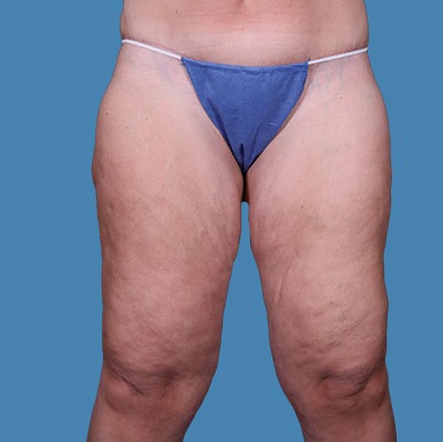 Before Thigh Lift Sugar land TX