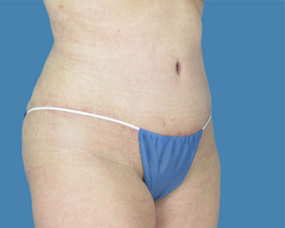 1740678607 body lipotuck p80 row 1 column 2