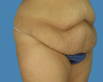 body lipotuck p106 row 1 column 1
