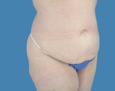 body lipotuck p53 row 1 column 1 (1)