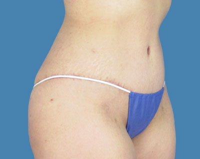 body lipotuck p71 row 1 column 2