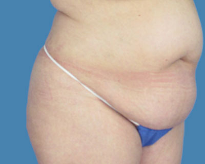 body lipotuck p73 row 1 column 1