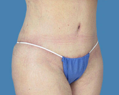 body lipotuck p73 row 1 column 2