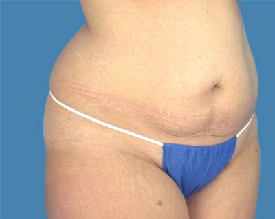 body lipotuck p74 row 1 column 1