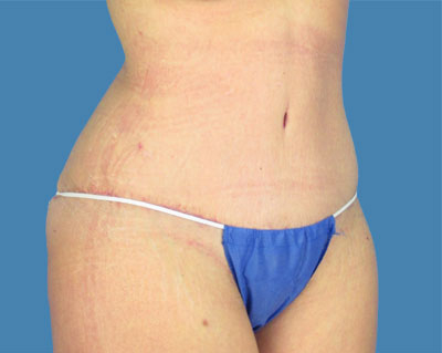body lipotuck p74 row 1 column 2
