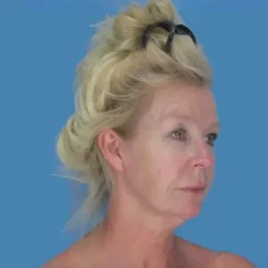 Before Image: Facelift