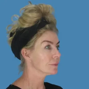 After Image: Facelift
